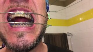 Horny deepthroat full of spit with braces and double headgear